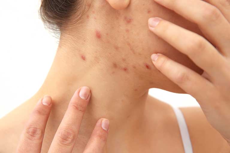 Acne diagnosis 2.jpg