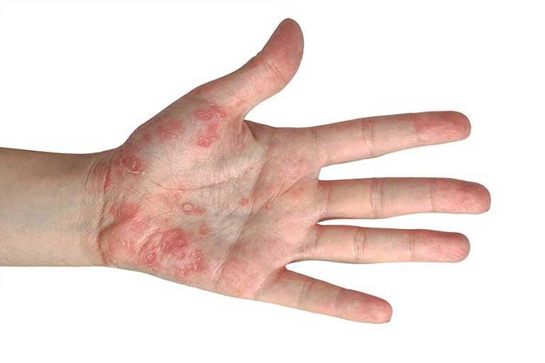 Risk factors psoriasis.jpg